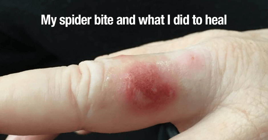 How to treat a spider bite and symptoms to look out for